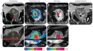 Cavernosal nerve functionality evaluation after magnetic resonance  imaging-guided transurethral ultrasound treatment of the prostate