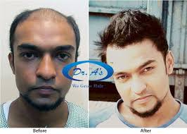 The team of expert hair transplant surgeons have created a it is safe to say that v care super speciality hair clinic is a pioneer in the field of hair transplant procedures in india. Best Hair Transplant In India Hair Transplant In Delhi Best Hair Transplant Hair Transplant In India Hair Transplant