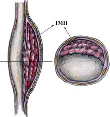 Dynamic Contrast Enhanced Mri Analysis For Prognosis Of Intracranial Dissecting Aneurysm With Intramural Haematoma After Endovascular Treatment An Observational Registry Study Stroke And Vascular Neurology Some aortic aneurysms burst, some don't.