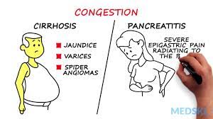 Splenomegaly Remember The 3 Primary Causes With Cip Youtube