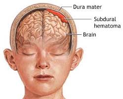 Dr. Arun L.Naik - Acute Subdural Hematoma