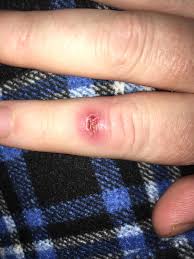 When should you see a health care provider? Update On My Infected Hair Follicle It S Healing Beautifully See Comments For More Popping