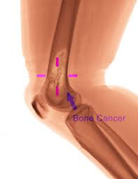 Image result for Osteosarcoma