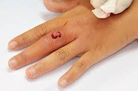 Identify sepsis patients 6 hours earlier. Blutvergiftung Sepsis Anzeichen Ursachen Behandlung Symptome Gesundheit De