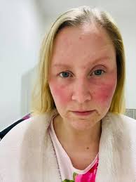 A question from the helpline: Have any of our members followed a diet  avoiding liberators of histamine? If so, how did you approach this, and do  you have any document or website