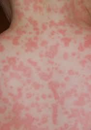 Antibiotic Allergy Or Just A Rash Quest For Health Kc