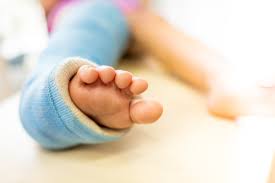 Image result for Fractures in Children