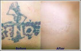 Pin On Before And After