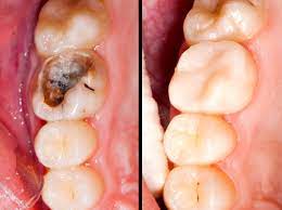 What is a composite filling? What Is White Fillings Calgary Dentist Sw Calgary Dental Clinic