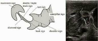 See more ideas about ultrasound, ge healthcare, transducer. Signs Of Chps 1 Cervix Sign 2 Mushroom Sign 3 Target Sign 4 Shoulder Sign 5 Double Track Sign Radiology Signs Stenosis