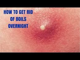 Wayne's home renovation projects (whrp) augenbrauen rasieren: How To Get Rid Of Boils Overnight Youtube Get Rid Of Boils Boil Remedies Home Remedy For Boils