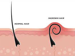 The post here's why you get ingrown. 10 Fast Easy Ways To Get Rid Of Deep Ingrown Hair Effectively