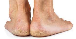 What Everybody Ought To Know About Dry Cracked Heels The Beltsville Foot And Ankle Center