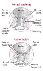 Image result for Hemorrhoid