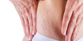 Cara menghilangkan stretch mark alami. 15 Cara Menghilangkan Stretch Mark Secara Alami Dan Cepat Merdeka Com