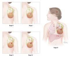 Although breast cancer can spread to any bone, the most common sites are the ribs, spine, pelvis, and long bones in the arms and legs. Staging Grade Breast Pathology Johns Hopkins Pathology