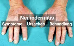 Neurodermitis Symptome Ursachen Therapie Praktischarzt