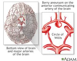 Aneurysm, widening of an artery that develops from a weakness or destruction of the medial layer of the blood vessel. Aneurysm Information Mount Sinai New York