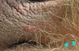 Guia De La Piel Psoriasis Genital