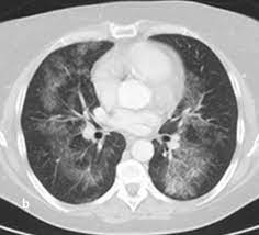 Pneumologie Unsere Krankheitsbilder Im Rontgenbild