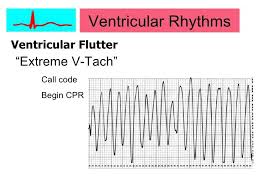 Pin By Nonas Arc On Ventricular Flutter Cardiovascular Emergencies Ventricular Tachycardia Myocardial Infarction