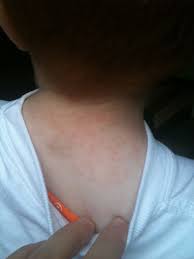 Image result for sweat rash on back baby