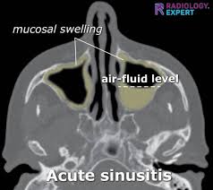 Image result for Sinus X Ray