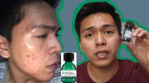 There is no doubt of its effectiveness in clearing up pimples and acne. How Tea Tree Oil Gave Me More Pimples Acne With Daily Pictures Tea Tree Oil Review Youtube