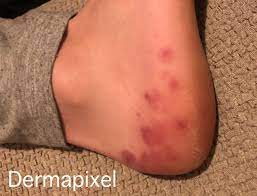 Lesiones En La Piel Uno De Los Sintomas Del Coronavirus