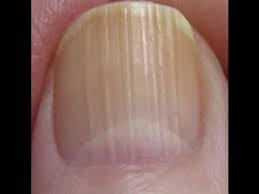 Do You Have These Vertical Ridges On Your Nails Palmistry Youtube Lines On Nails Nail Ridges Vertical Nail Ridges