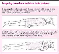 Decorticate Posturing Nursing Study Guide Acute Nursing Medical Knowledge