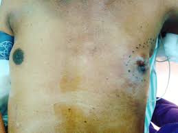 This is commonly caused due to the increased level of estrogen than testosterone levels in males. Male Breast Cancer Random Reflections Of A Breast Cancer Surgeon