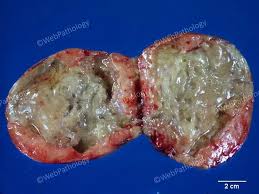 Image result for Liposarcoma