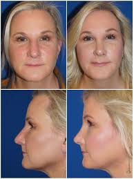 Rhinoplasty Surgery Center of Chattanooga