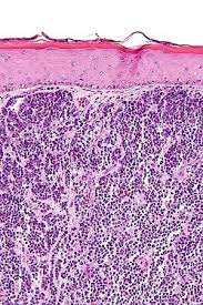 Incidence 0.4/100,000 in 2001 (up from 0.1/100,000 in 1986). Merkel Cell Carcinoma Libre Pathology