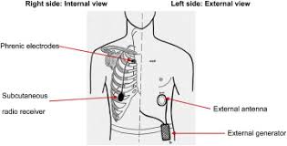 Intrathoracic Phrenic Pacing A 10 Year Experience In France Sciencedirect