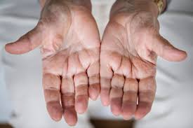 What Should I Do If There Is A Lump In The Palm Of My Hand Midwest Hand