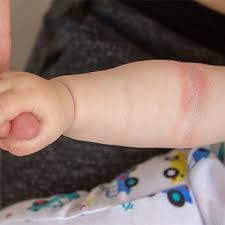 Image result for sweat rash on back baby