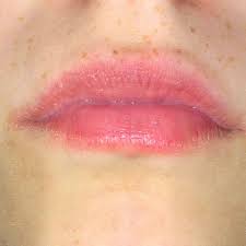 Was Konnte Der Grund Fur Schmerzende Lippen Sein Schmerzen Wunde Lippe
