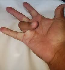 Symptoms Of Dupuytren S The British Dupuytren S Society