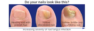 Toe fungus feeds on keratin and can affect the toes or toenails. Laser Hair Removal For Fungal Nail Infections Laser Treatments Exeter Medical