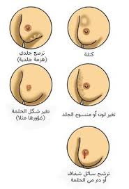 سرطان الثدي المعرفة