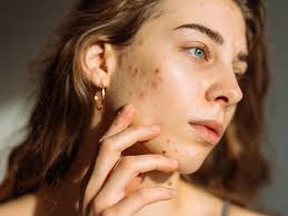Image result for acne face