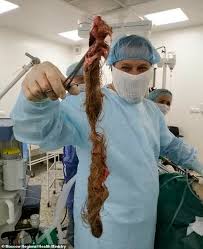 There have also been concerns that benign cysts may turn cancerous if left in place or that a cyst may have been misclassified at the initial ultrasound scan. Russian Woman 30 Has Enormous Cysts Filled With Hair Removed From Her Ovaries Sound Health And Lasting Wealth