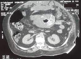 Maybe you would like to learn more about one of these? Benign Cystic Mesothelioma Of The Peritoneum A Case Report And Literature Review World Journal Of Emergency Surgery Full Text