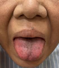 Image result for brown tongue symptoms