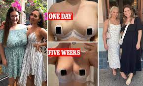 Nurse, 27, who was embarrassed by her 16H cup chest gets 'life-changing'  reduction | Daily Mail Online