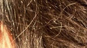 Wash hair with ordinary shampoo apply lots of conditioner (any conditioner will do) How To Get Rid Of Head Lice And Nits With Vinegar And Conditioner Remedygrove
