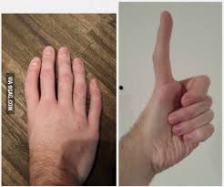 Five Fingers No Thumb Cursed Images Funny Images Genetics