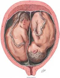 Image result for Multiple Gestation